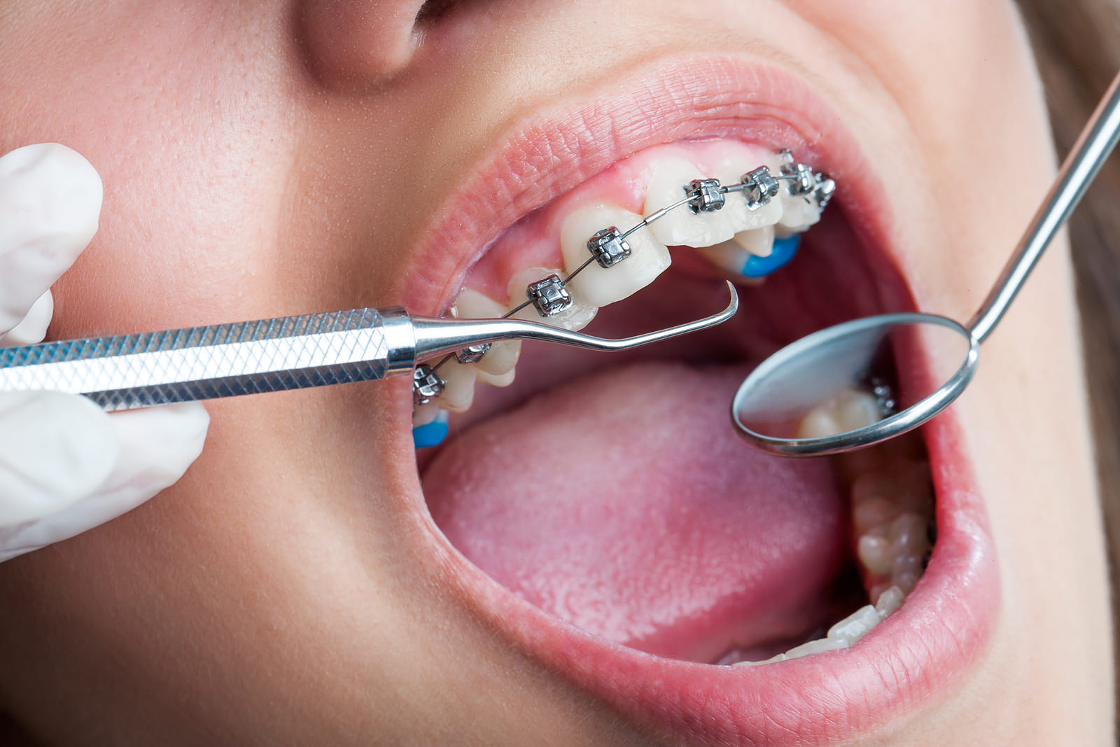 Close up image of a braces patient getting her teeth checked
