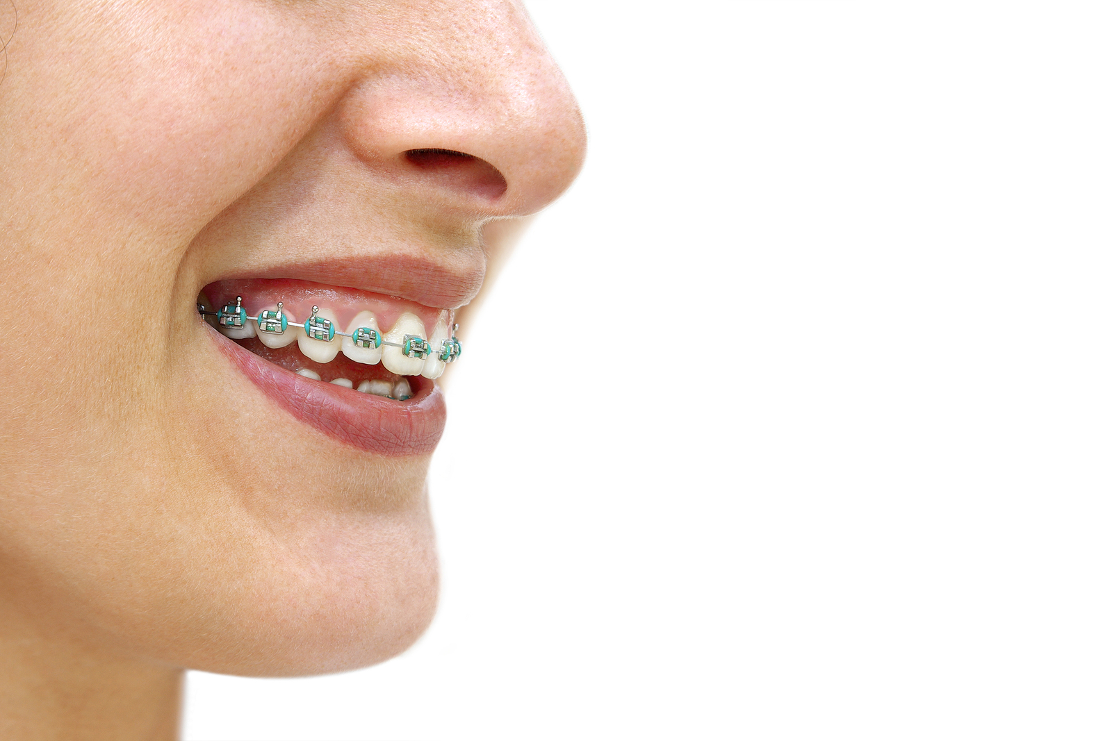 female patient wearing braces