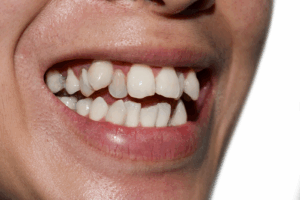 teen with overlapping teeth