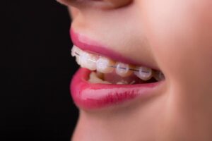 Ceramic braces for sensitive teeth