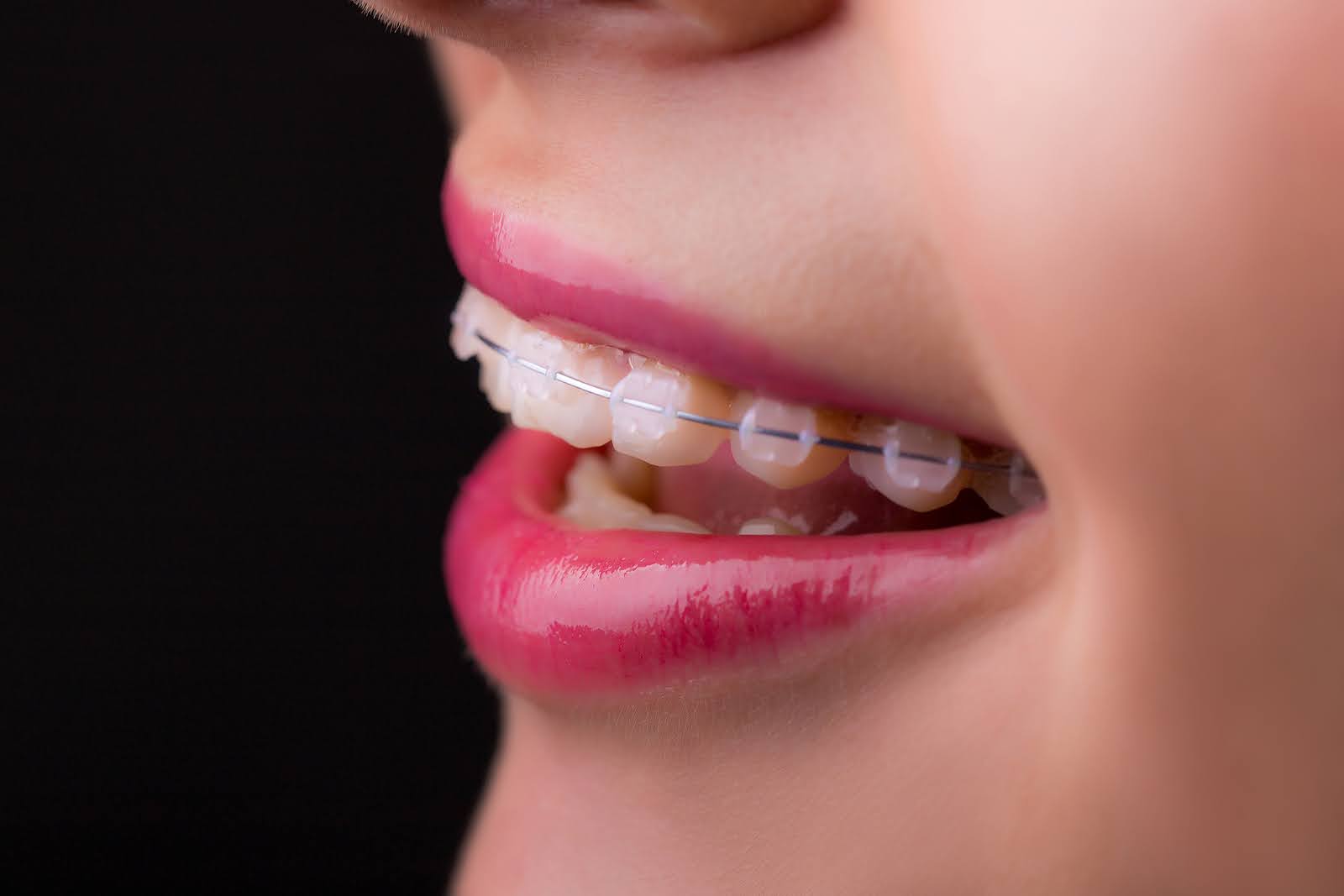 Ceramic braces for sensitive teeth