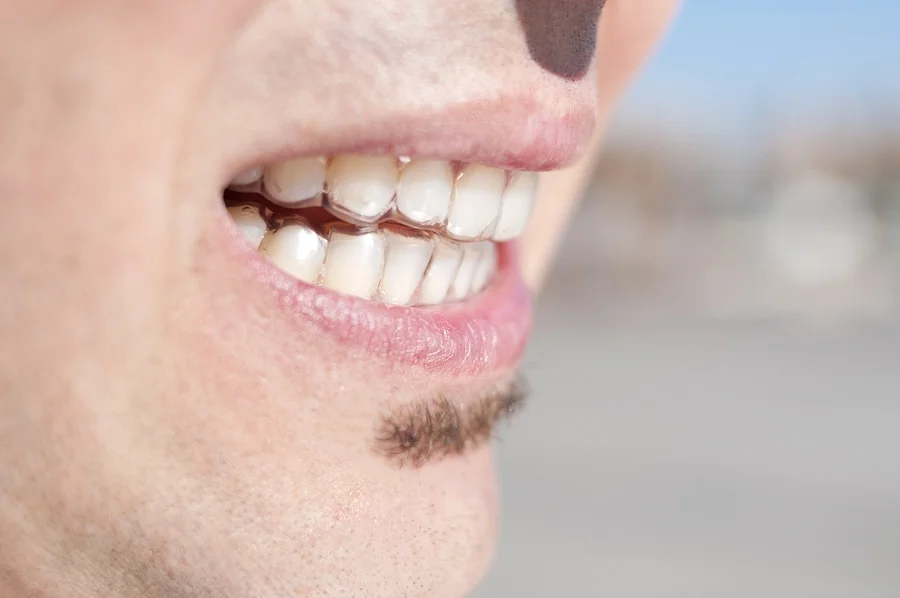 closeup of the mouth of a young man who is wearing clear retainers